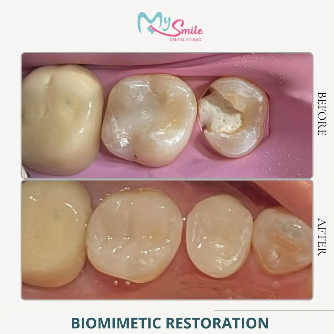 Before and after a biomimetic restoration: broken, decayed back teeth rebuilt to their natural shape
