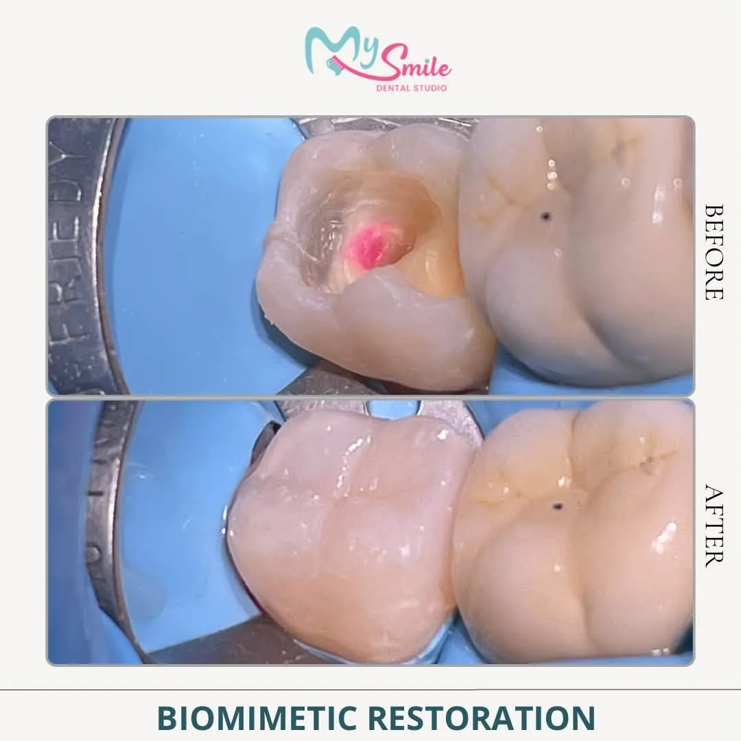 Before and after a biomimetic restoration: a cleaned-out molar rebuilt with a tooth-coloured filling