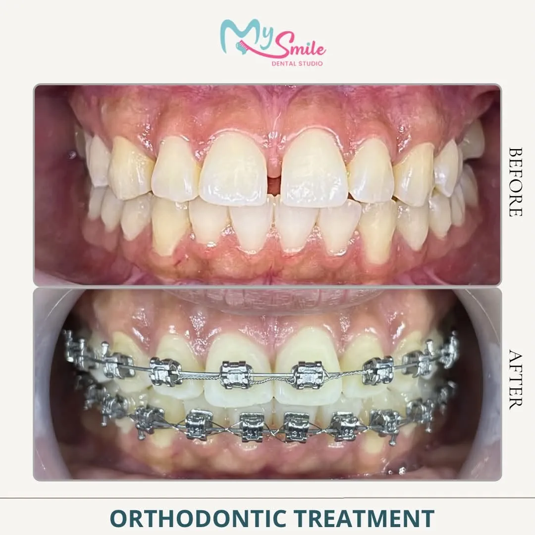 Before and after braces: a gap between the upper front teeth, then metal braces fitted to close it