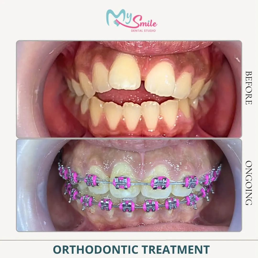 Before and during braces treatment: crowded, gapped front teeth, then pink braces fitted