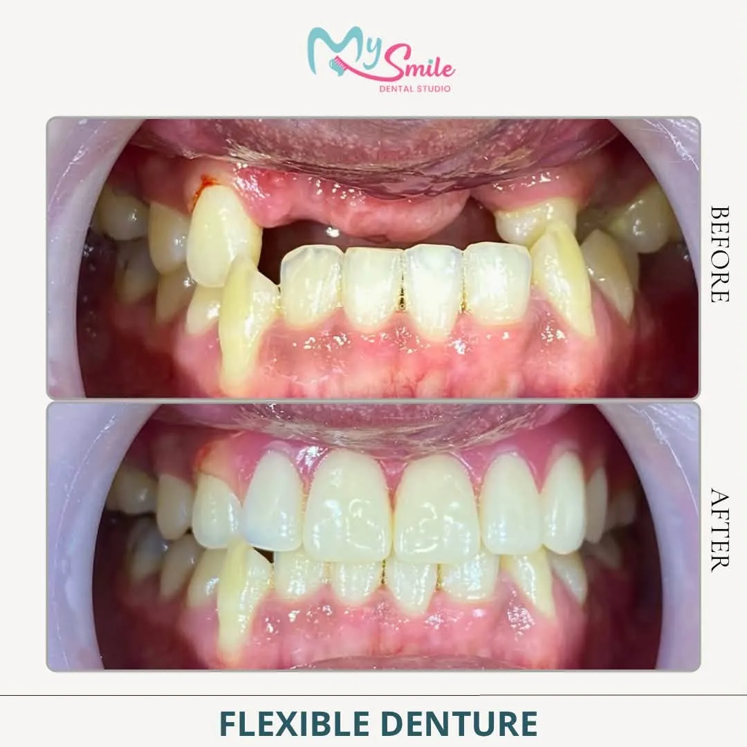 Before and after a flexible denture: gaps from missing upper teeth filled with natural-looking teeth