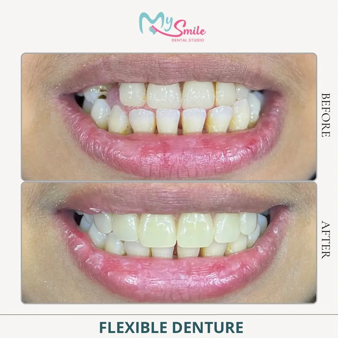 Before and after a flexible denture: a gap between the lower teeth filled