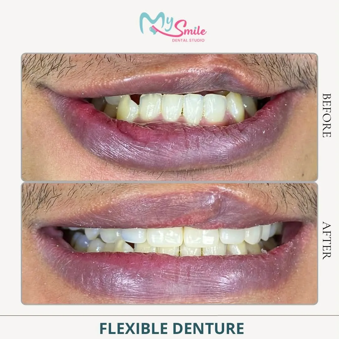 Before and after a flexible denture: missing side teeth replaced for a fuller smile