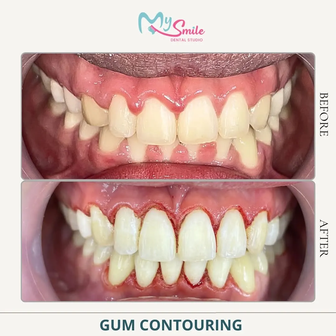 Before and right after gum contouring: excess gum trimmed back to show more of the upper teeth