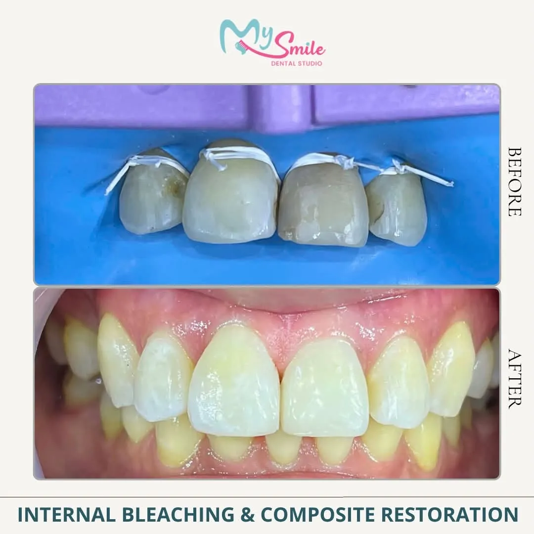 Before and after internal bleaching and composite restoration: dark, discoloured front teeth made bright and even