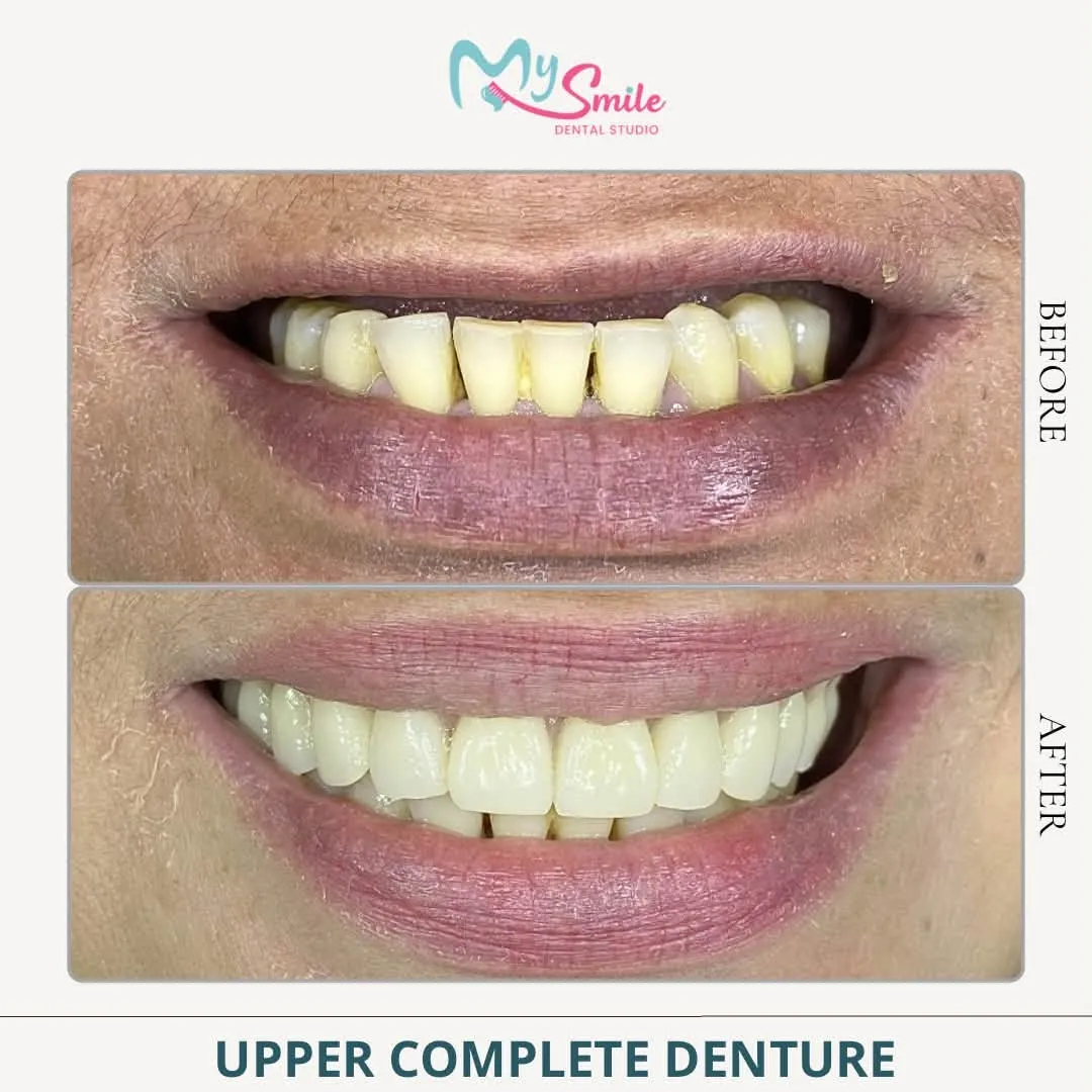 Before and after an upper complete denture: worn, yellowed upper teeth replaced with an even, white set