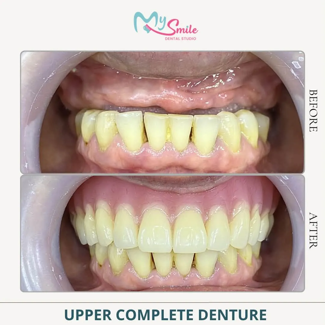 Before and after an upper complete denture: worn upper teeth replaced with a full, even set