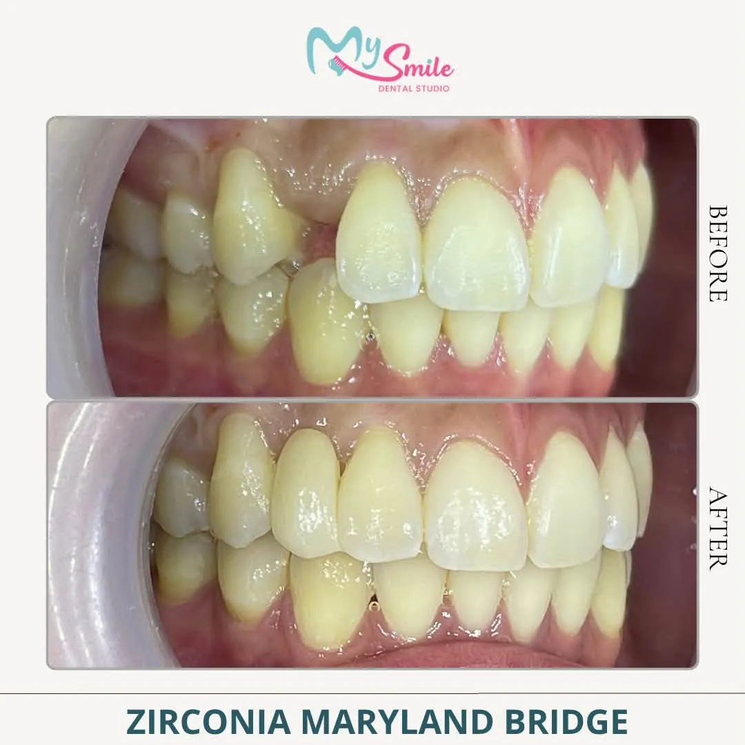 Before and after a zirconia Maryland bridge: a missing front tooth replaced to match its neighbours