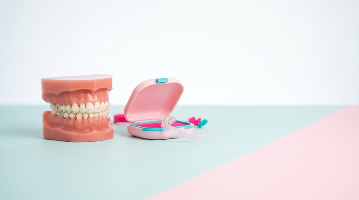 Dental model with ceramic braces beside a clear aligner and its pink case